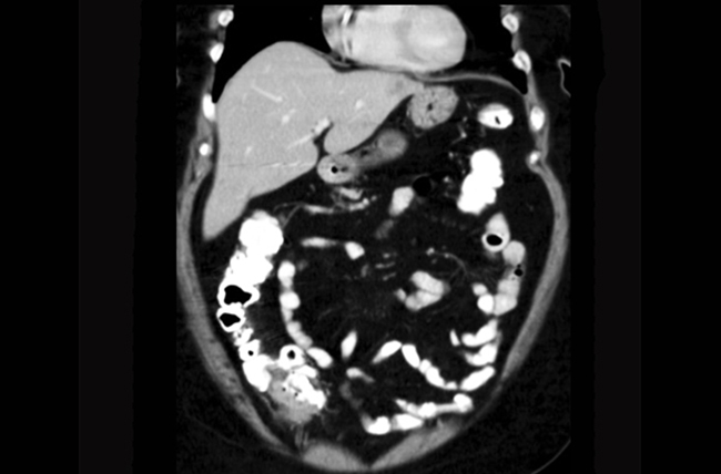 CT abdomen and pelvis revealing a cecal cancer